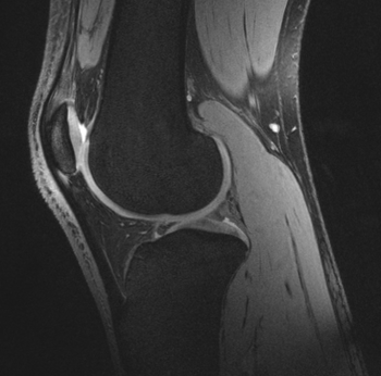 Knee MRI scan